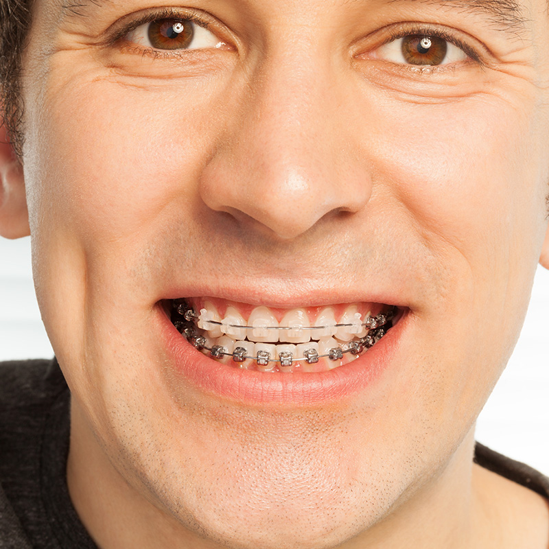 Braces