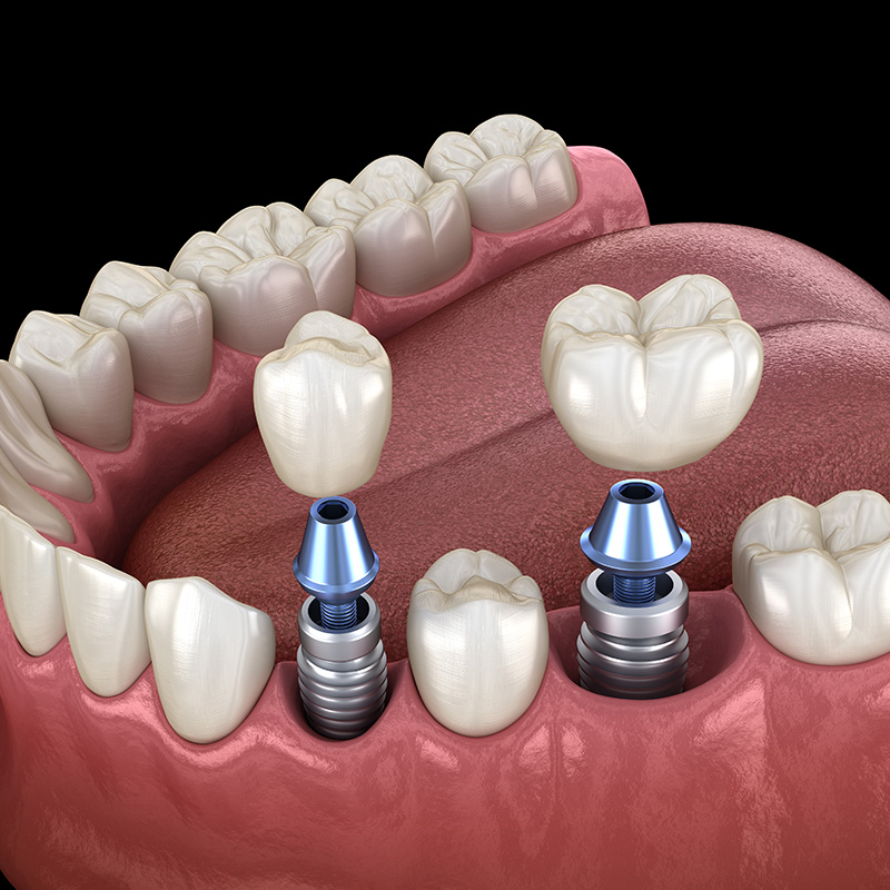 Dental Implants 3D Illustration