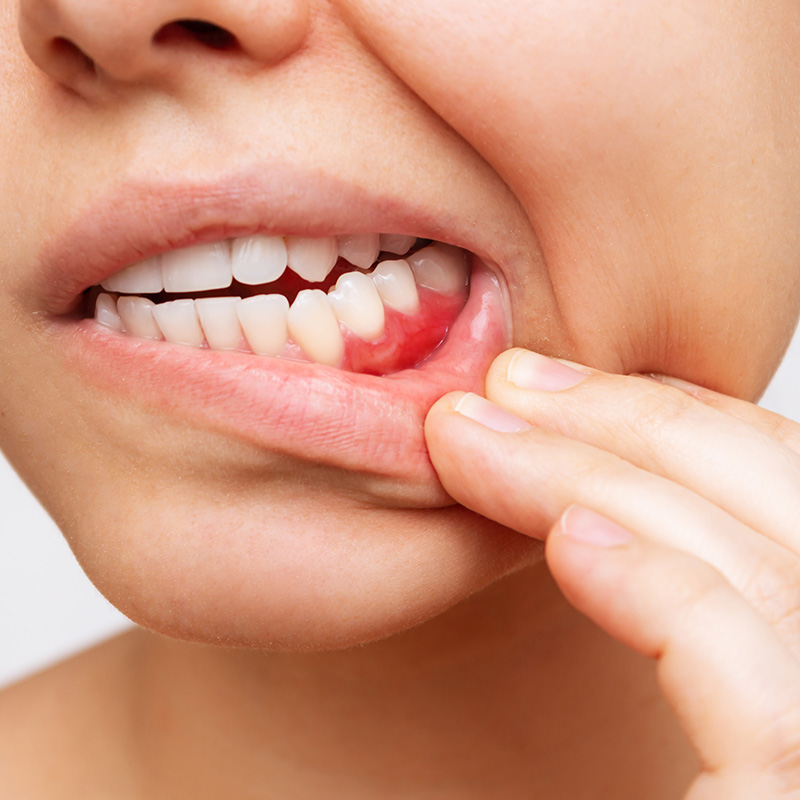 Woman Pulling Back Lip to Reveal Gum Redness